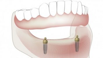 overdenture system